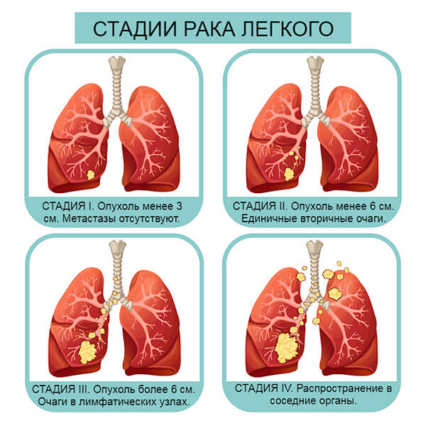 Метастазы в легких: лечение, симптомы, паллиативная помощь