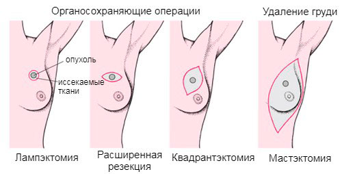 Опухоли молочных желез: стадии, симптомы, лечение