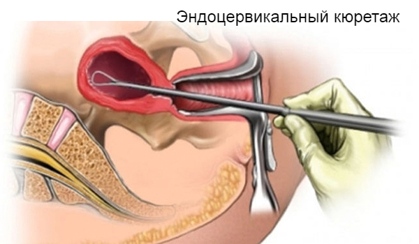 Эрозия шейки матки