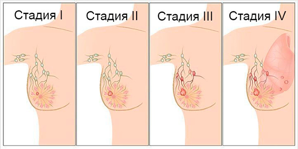 РАК МОЛОЧНОЙ ЖЕЛЕЗЫ - ОПУХОЛЬ ГРУДИ